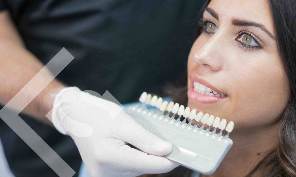 dental veneers (1)
