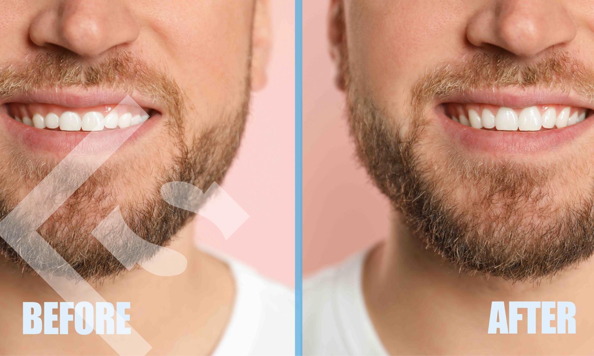 Gummy Smile Fix: Why Gum Contouring Works Wonders