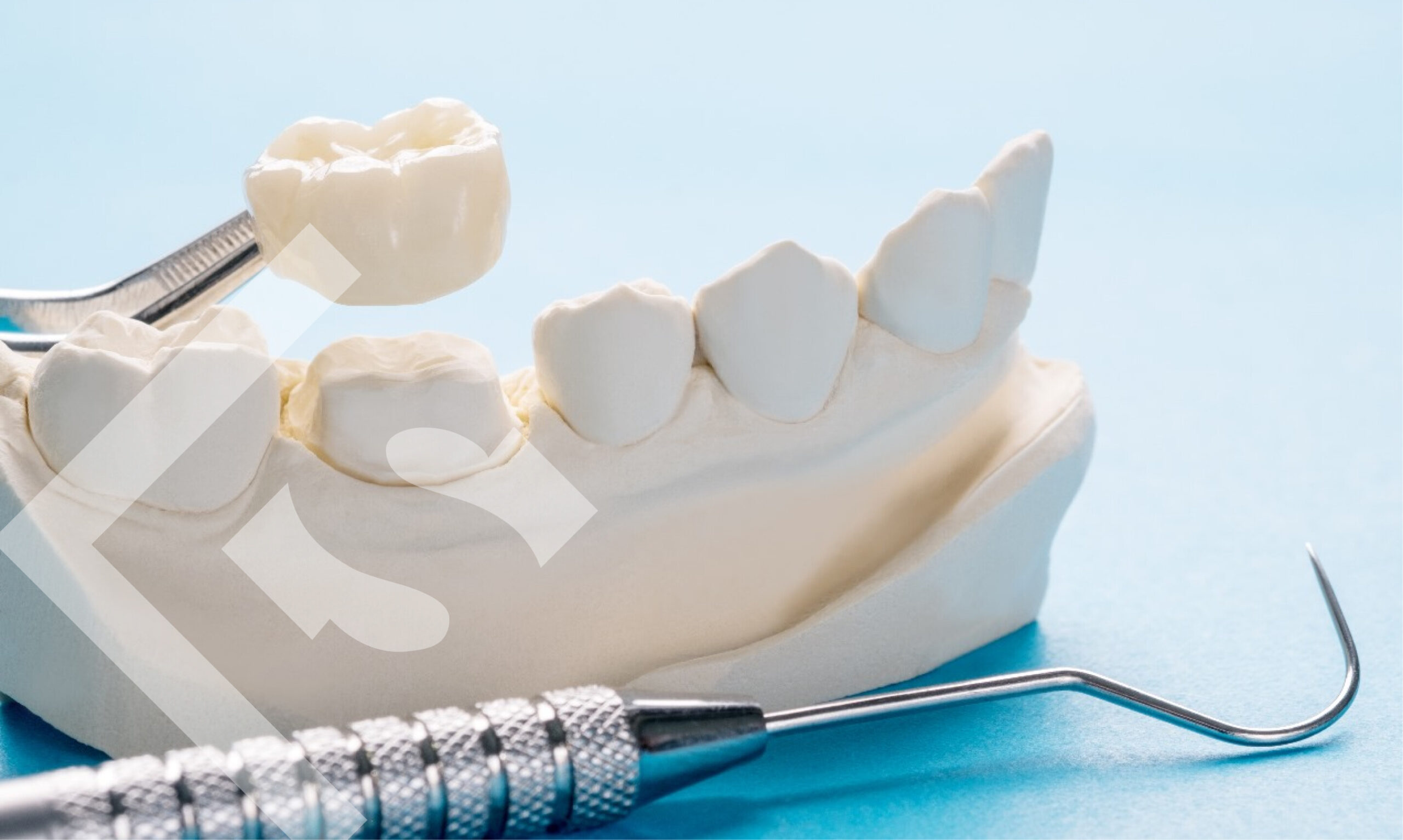 Cracking the Code: Frequently Asked Questions About Dental Crowns