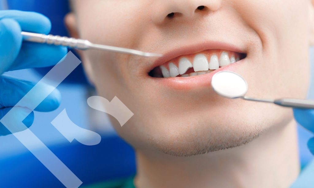 dental bonding
