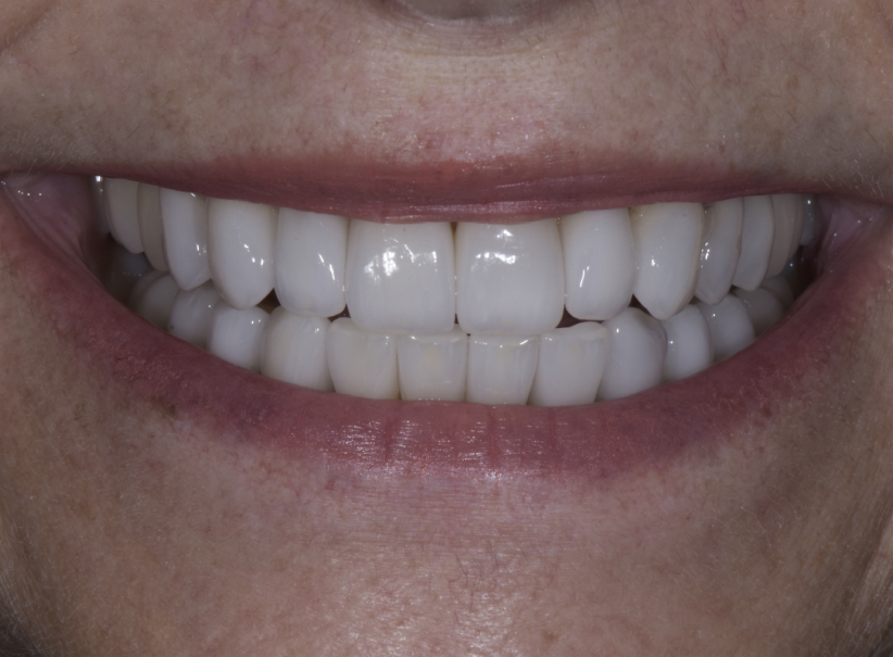 crowns veneers 3 after, aacd accredited
