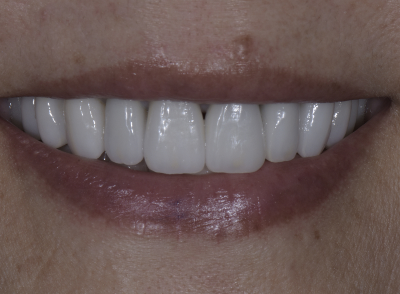 crowns4 after