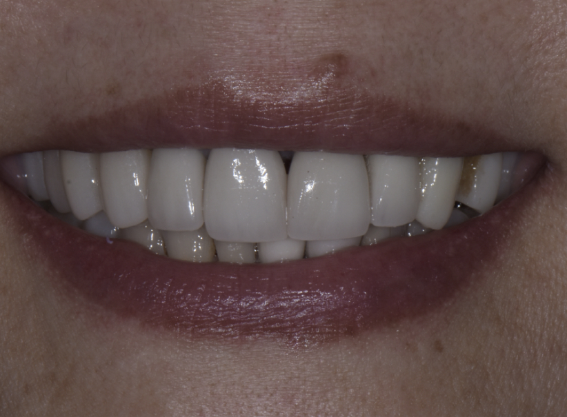 crowns4 before crowns4 before