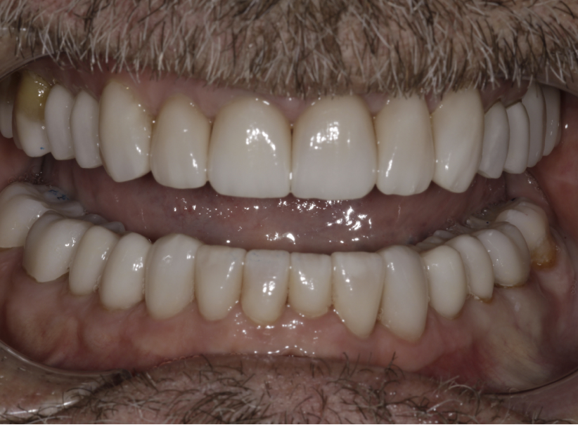 full crowns veneers 2 after