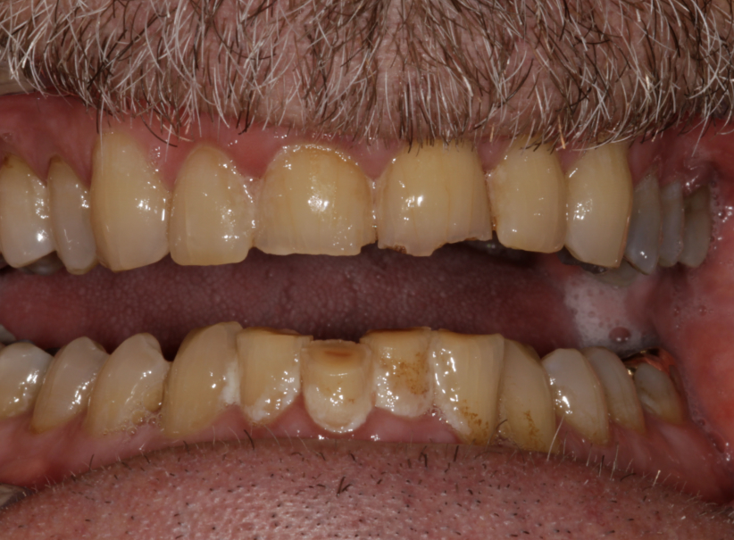 full crowns veneers 2 before full crowns veneers 2 before