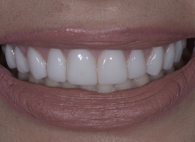 veneer3 after