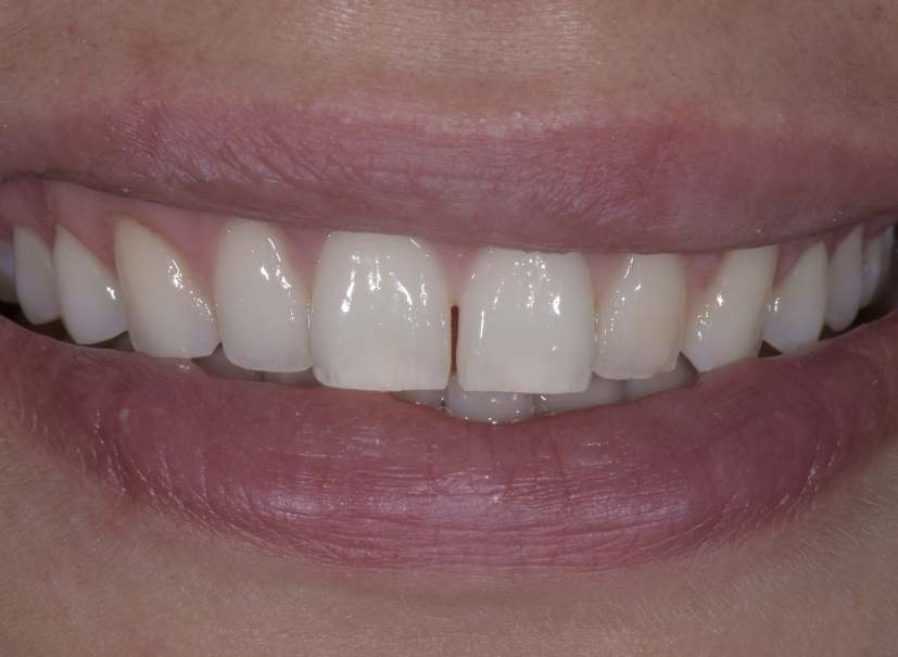 veneer3 before veneer3 before