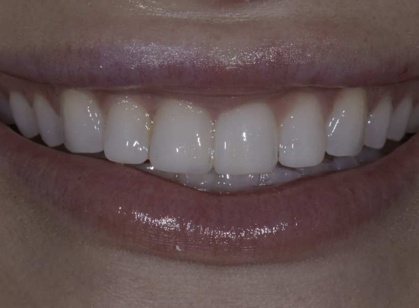 veneers 14 after