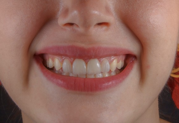 lum smiles gingival contouring, cosmetic dentistry newport beach, big gums