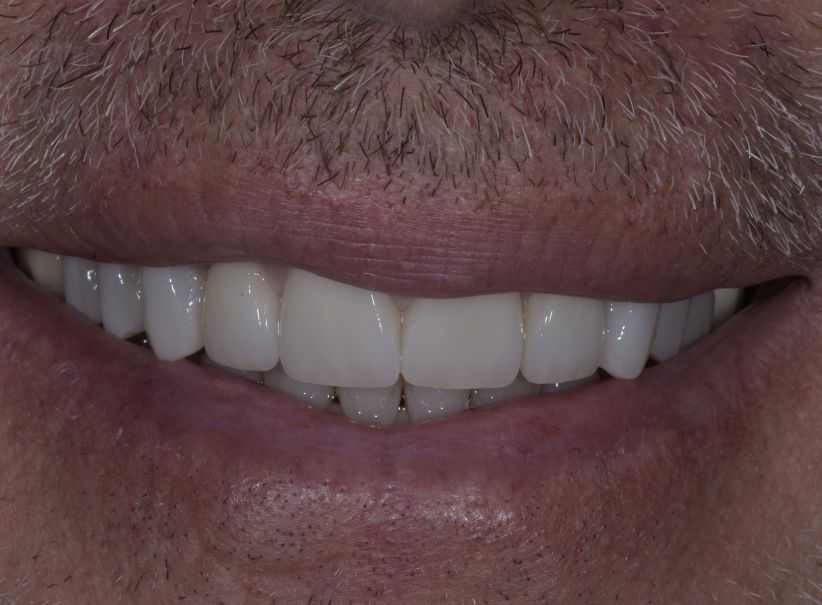 5 clear aligner veneer smile makeover after