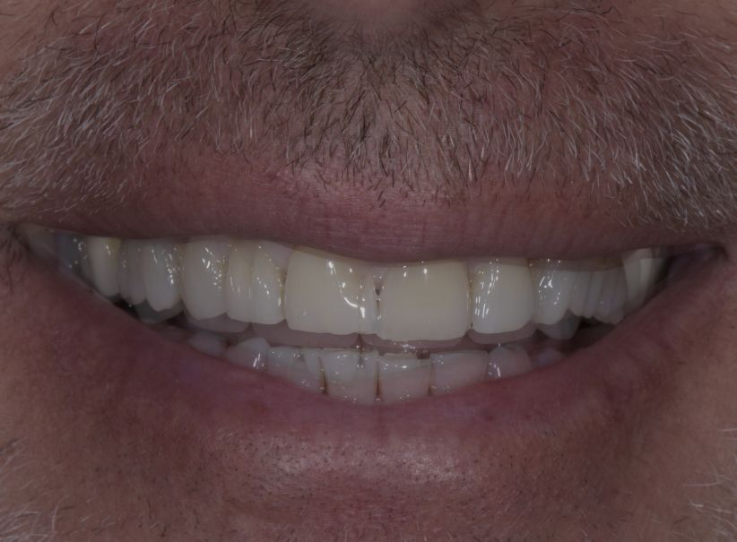5 clear aligner veneer smile makeover before