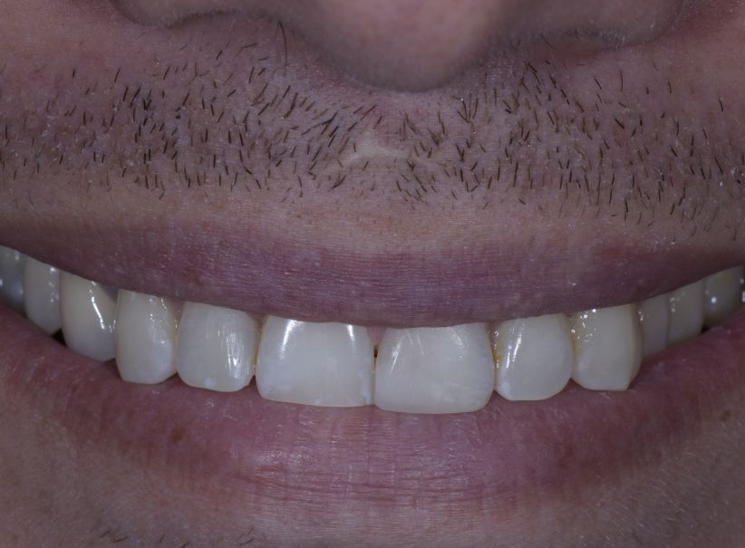 advanced composite bonding smile repair after