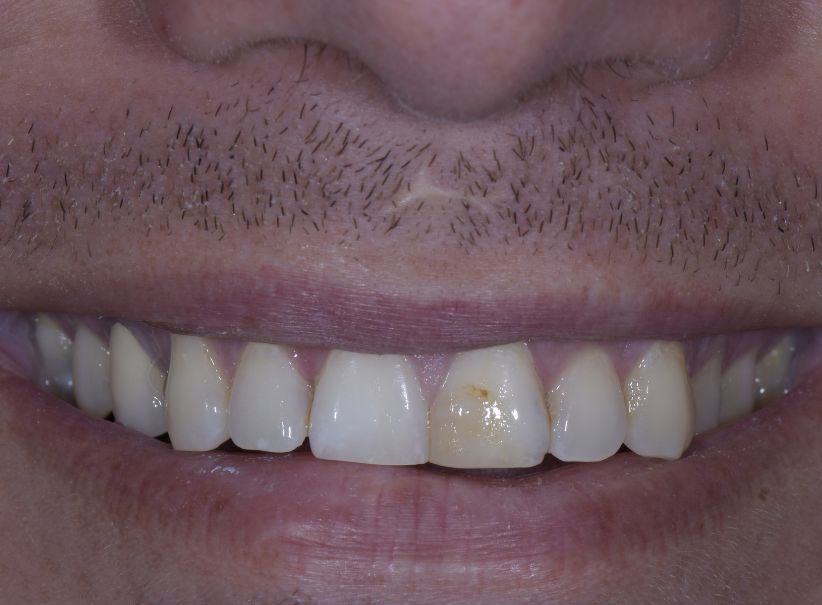 advanced composite bonding smile repair before advanced composite bonding smile repair before