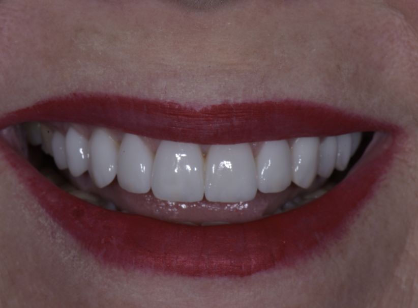 aligner and veneer smile harmony after