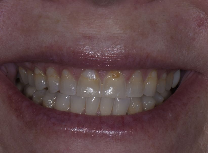 aligner and veneer smile harmony before
