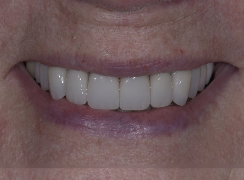 bridges & porcelain fillings luminous smile gallery after