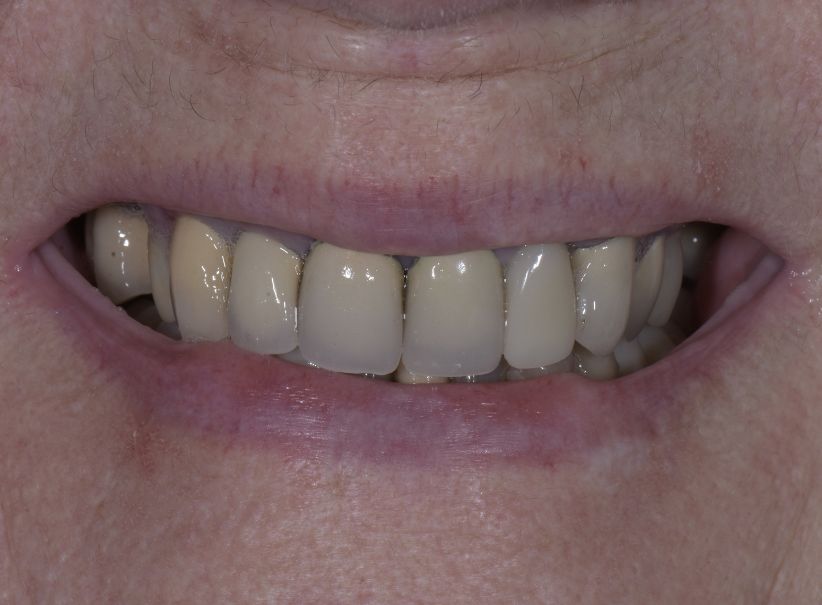 bridges & porcelain fillings luminous smile gallery before bridges & porcelain fillings luminous smile gallery before