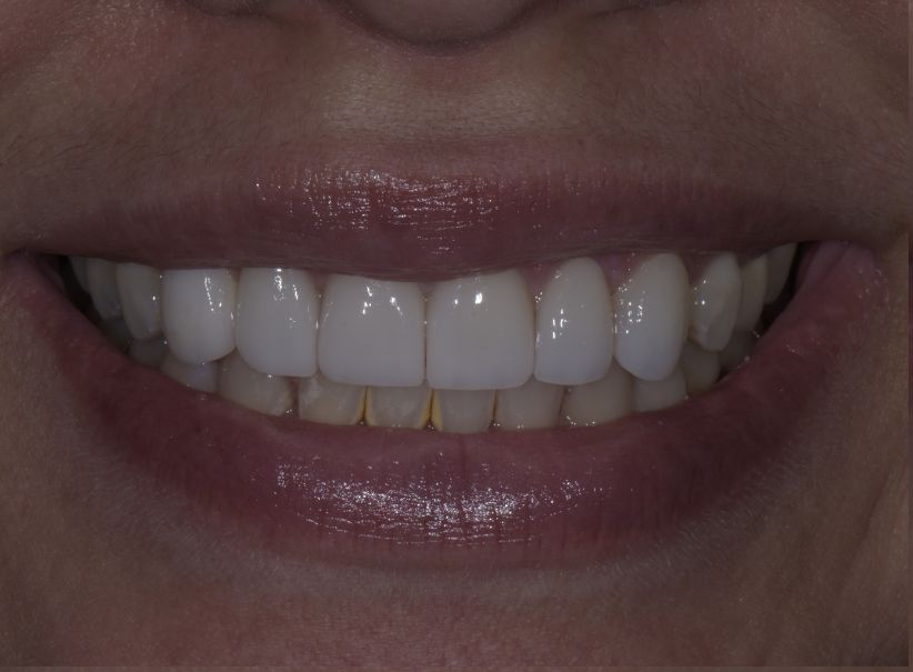clear aligner veneer smile restoration service in luminous smiles after