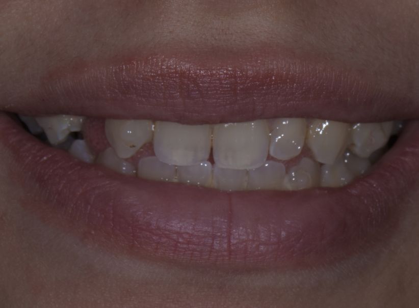 clear aligner veneer smile restoration service in luminous smiles before clear aligner veneer smile restoration service in luminous smiles before