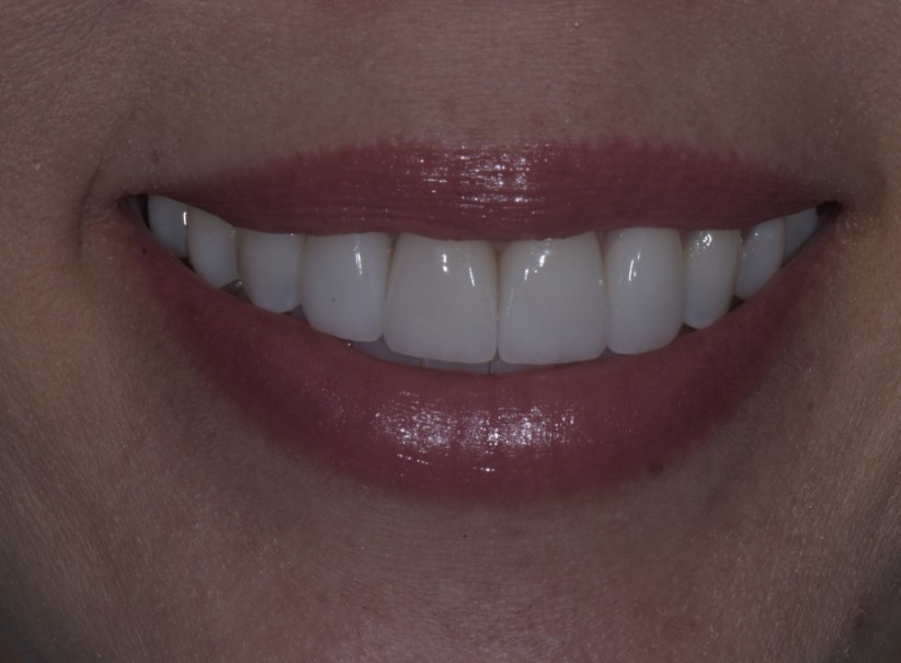 clear aligner veneer smile balance after