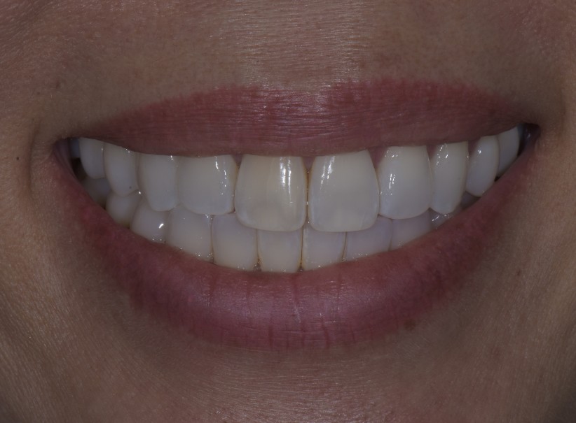 clear aligner veneer smile balance before clear aligner veneer smile balance before