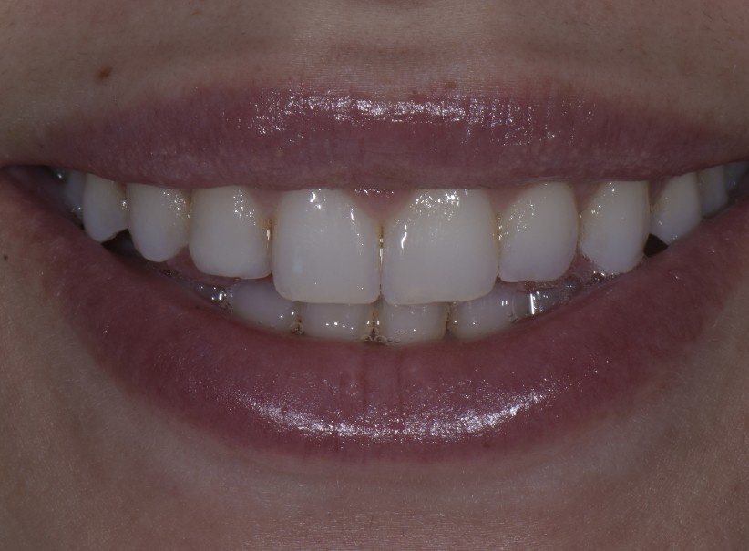 composite bonding lateral incisor repair before