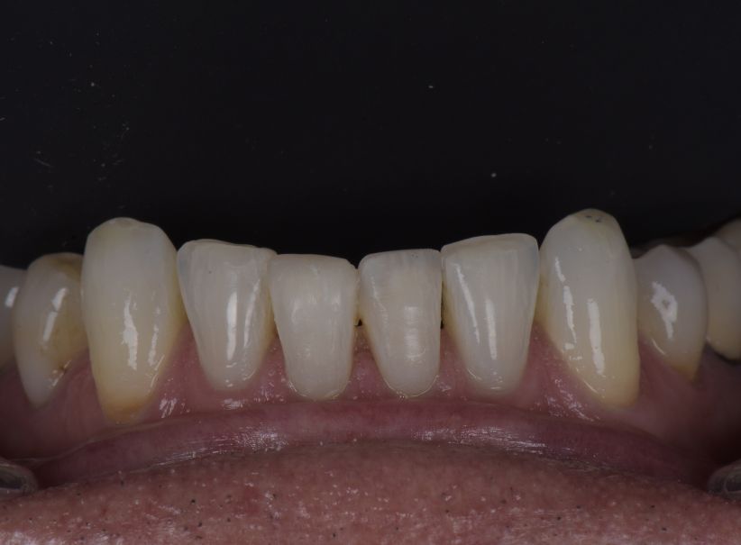 composite repair after bite alignment after