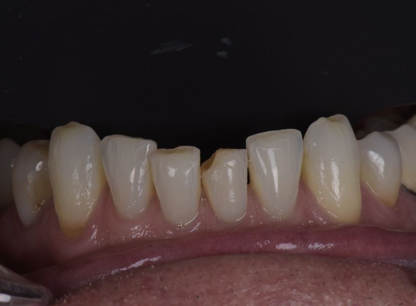 composite repair after bite alignment before