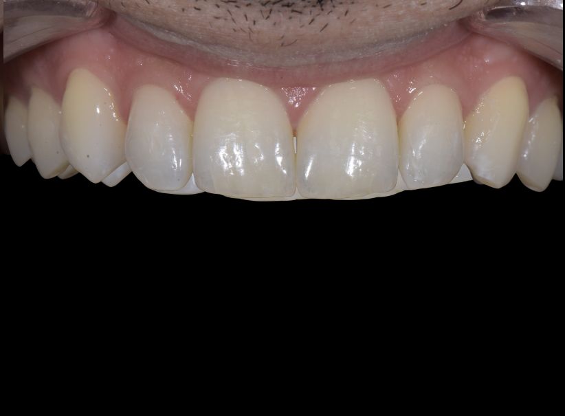 composite restoration lateral incisor after