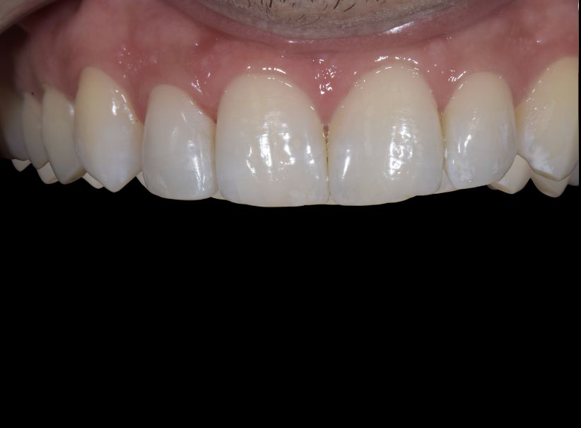 composite restoration lateral incisor before