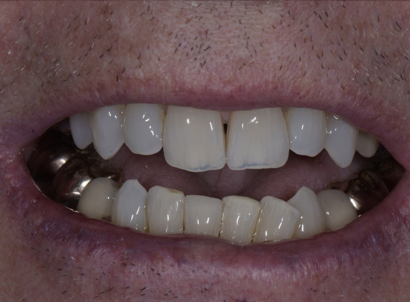 composite repair lower front tooth lum smiles after