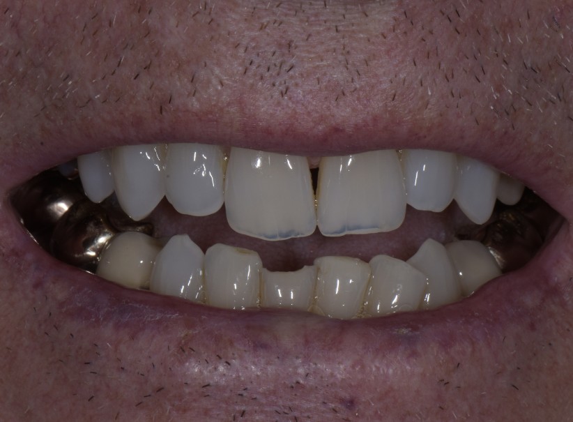 composite repair lower front tooth lum smiles before composite repair lower front tooth lum smiles before
