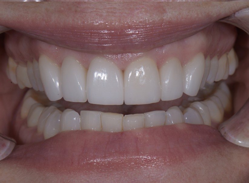conservative veneer smile enhancement after