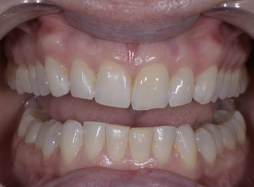 conservative veneer smile enhancement before conservative veneer smile enhancement before