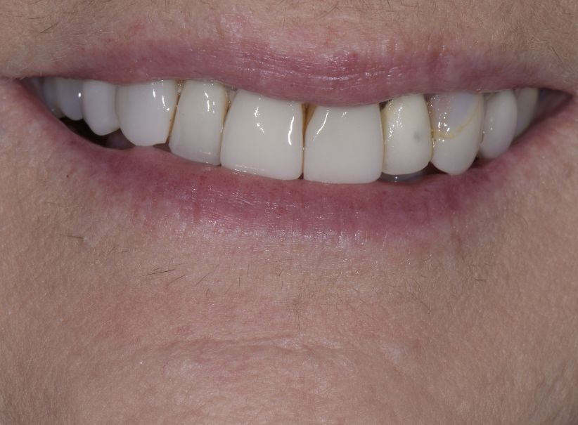 eight veneer smile renewal before eight veneer smile renewal before
