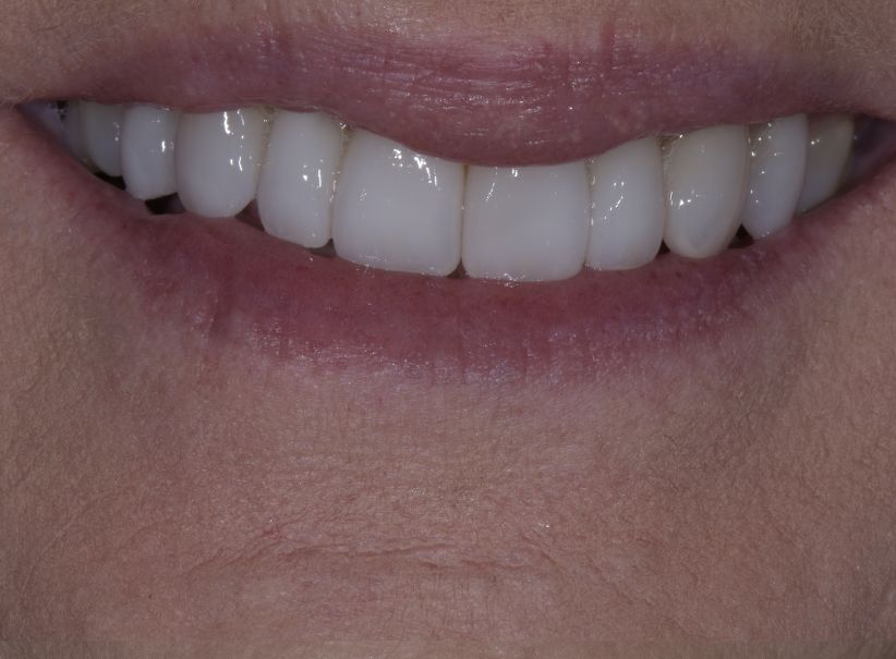 eight veneer smile renewal after