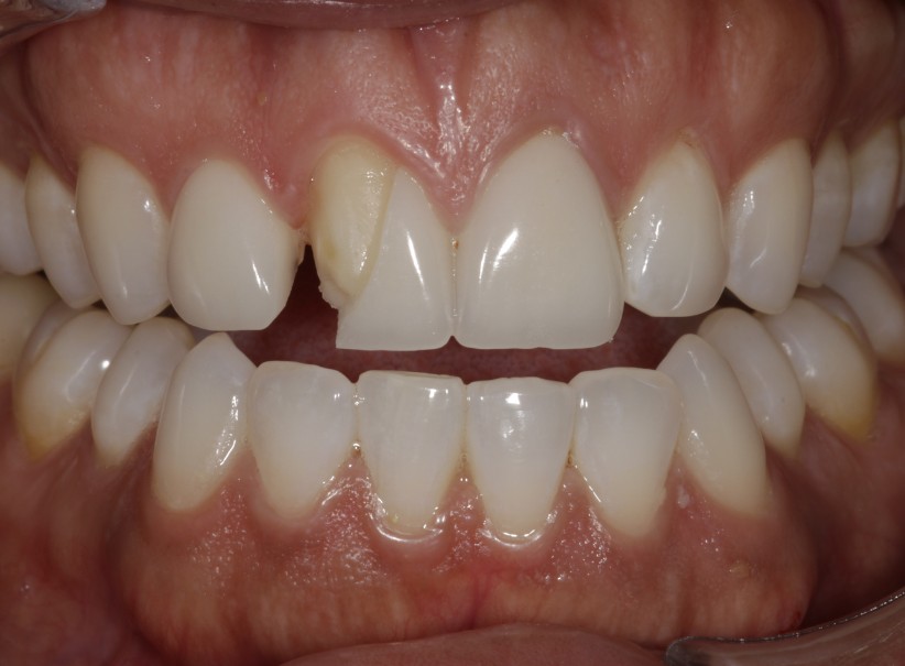 precise veneer shade match restoration before precise veneer shade match restoration before