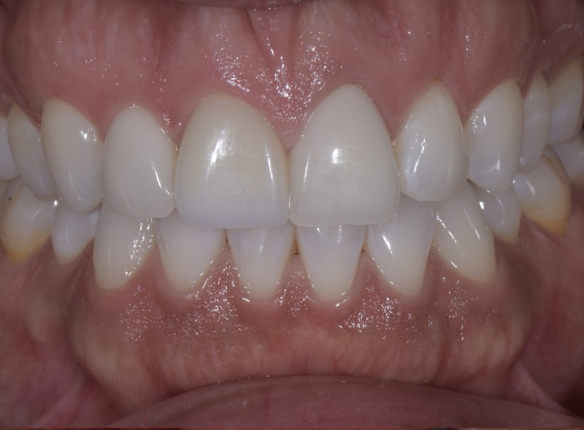 precise veneer shade match restoration after