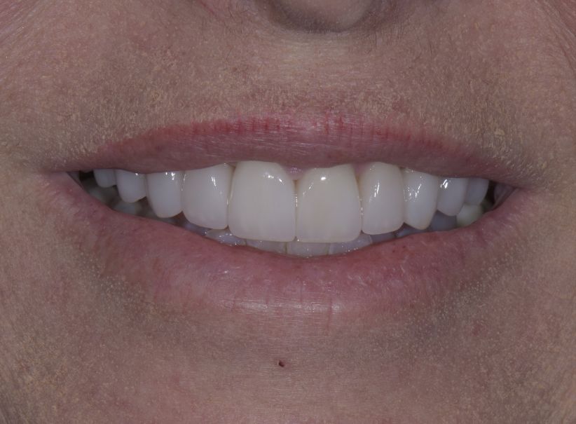 ten veneer anti aging smile makeover after