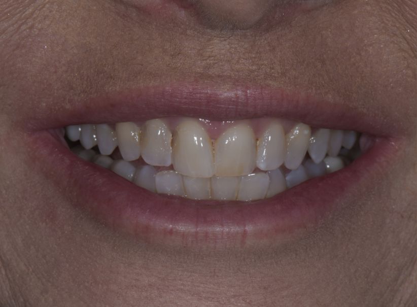 ten veneer anti aging smile makeover before ten veneer anti aging smile makeover before