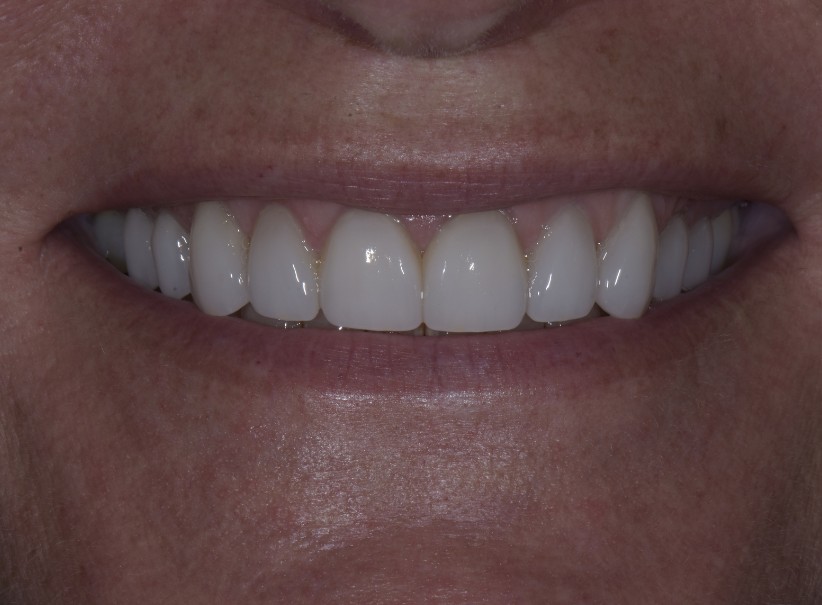tetracycline stain smile makeover after