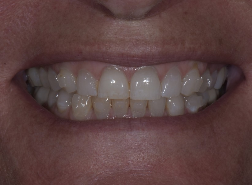 tetracycline stain smile makeover before
