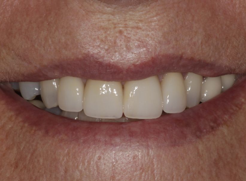after veneer restoration after dental trauma