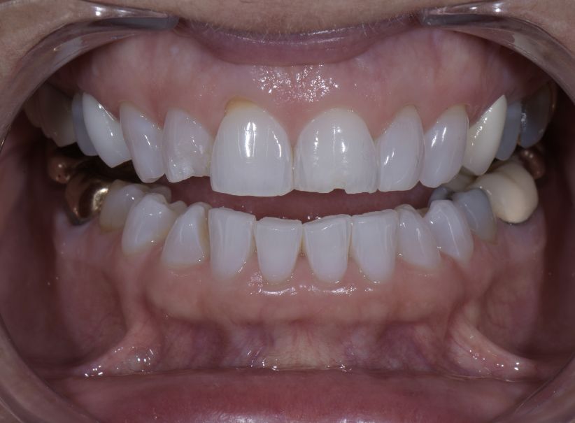 before composite bonding front tooth repair - Newport Beach Cosmetic Dentistry