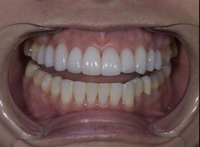 bite correction veneer smile renewal after