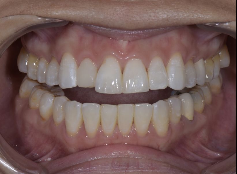 bite correction veneer smile renewal before bite correction veneer smile renewal before