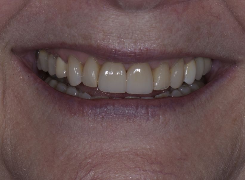 clear aligner veneer front smile fix after