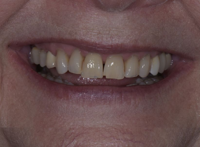 clear aligner veneer front smile fix before clear aligner veneer front smile fix before