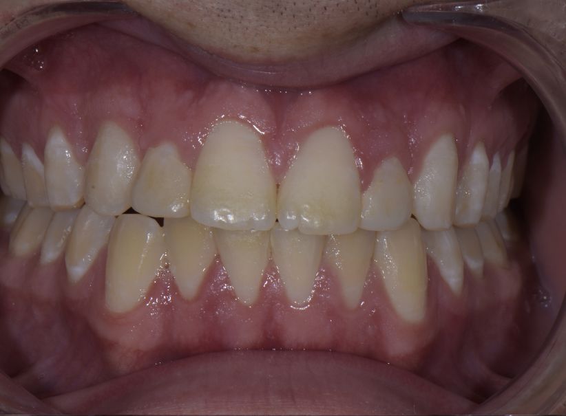 clear aligner veneer smile design after