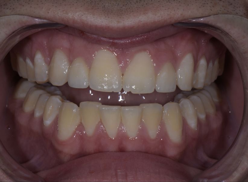clear aligner veneer smile design before clear aligner veneer smile design before